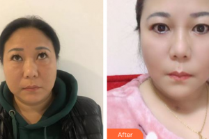 佛山醫(yī)博士醫(yī)療美容門診部陳偉彬整形價格表附外切去眼袋案例展示