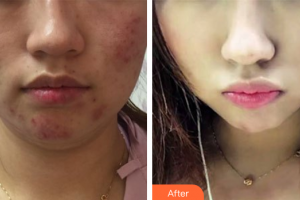 佛山醫(yī)博士醫(yī)療美容門診部鄧勤煥整形價格表附果酸活膚祛痘案例展示