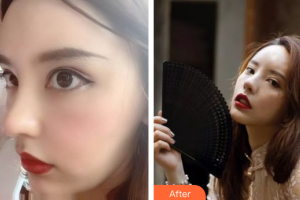 佛山醫(yī)博士醫(yī)療美容門診部林茂輝整形價格表附超微小氣泡案例展示