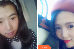 佛山凱瑟琳醫(yī)學(xué)美容醫(yī)院歐陽海濱整形價格表附明眸眼部手術(shù)案例展示