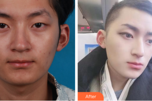 佛山凱瑟琳醫(yī)學(xué)美容醫(yī)院劉生整形價格表附眼部整形案例展示