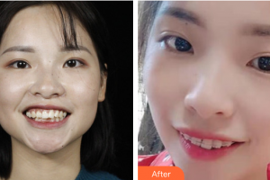 佛山君美醫(yī)療美容醫(yī)院黃海整形價格表附牙齒矯正案例展示