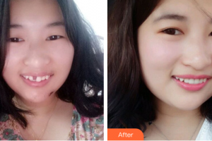 佛山君美醫(yī)療美容醫(yī)院王麗君整形價格表附種植牙案例展示