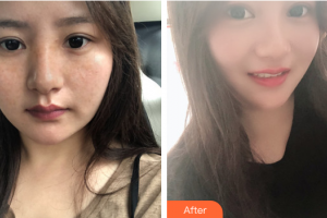 佛山市禪城中心醫(yī)院整形美容科羅春源整形價格表附祛雀斑案例展示