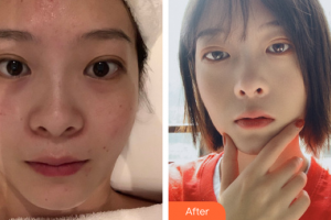 佛山廣大壹美醫(yī)療美容門診部龍博整形價格表附小氣泡案例展示