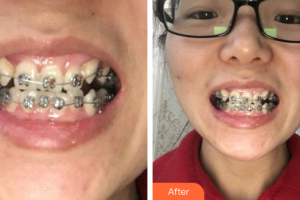 佛山君美醫(yī)療美容醫(yī)院鄭旭輝整形價格表附金屬矯正案例展示