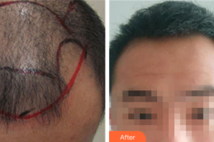 佛山廣大壹美醫(yī)療美容門診部應(yīng)曉紅整形價格表附種植發(fā)際線案例展示