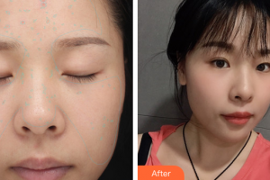 佛山華廈眼科醫(yī)院徐莉整形價格表附美白嫩膚NIR牛奶光案例展示