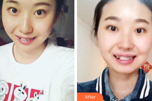 佛山拜博口腔醫(yī)院林寶輝整形價格表附自鎖托槽矯正案例展示