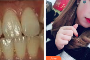 佛山拜博口腔醫(yī)院孟偉整形價格表附隱適美牙齒矯正案例展示