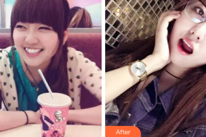 佛山拜博口腔醫(yī)院駱?biāo)既A整形價格表附金屬矯正案例展示