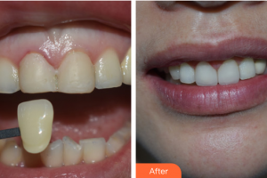 佛山拜博口腔醫(yī)院余敏整形價格表附口腔美學(xué)貼面案例展示