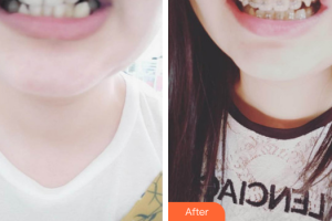 佛山拜博口腔醫(yī)院林江琛整形價格表附自鎖矯正案例展示