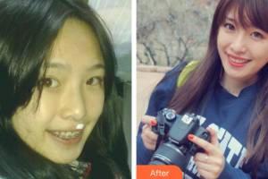 佛山市禪城區(qū)人民醫(yī)院口腔?？漆t(yī)院許家鏘整形價格表附金屬矯正案例展示