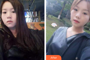 佛山市禪城區(qū)人民醫(yī)院口腔?？漆t(yī)院陳月明整形價格表附時代天使矯正案例展示