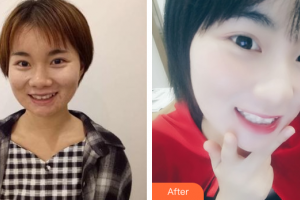 佛山市禪城區(qū)人民醫(yī)院口腔專科醫(yī)院陳覺清整形價格表附隱形矯正案例展示