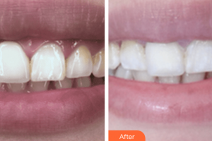 佛山南海中大口腔醫(yī)院陳亞梅整形價(jià)格表附超聲波洗牙案例展示