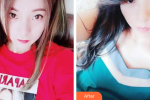 佛山順德口腔醫(yī)院蔣雅賢整形價(jià)格表附超聲波潔牙案例展示