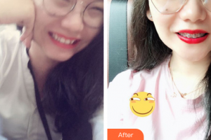 佛山市禪城區(qū)人民醫(yī)院口腔專(zhuān)科醫(yī)院鄒康元整形價(jià)格表附金屬矯正案例展示