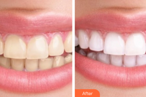 佛山市禪城區(qū)人民醫(yī)院口腔專(zhuān)科醫(yī)院莫振飛整形價(jià)格表附冷光美白案例展示