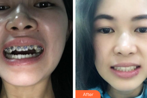 佛山順德口腔醫(yī)院余興華整形價(jià)格表附金屬矯正案例展示