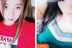 佛山南海中大口腔醫(yī)院陳麗整形價(jià)格表附超聲波潔牙案例展示