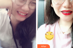 佛山市禪城區(qū)人民醫(yī)院口腔專(zhuān)科醫(yī)院李業(yè)榮整形價(jià)格表附金屬矯正案例展示