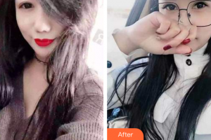 佛山市禪城區(qū)人民醫(yī)院口腔專(zhuān)科醫(yī)院符鎮(zhèn)南整形價(jià)格表附時(shí)代天使矯正案例展示