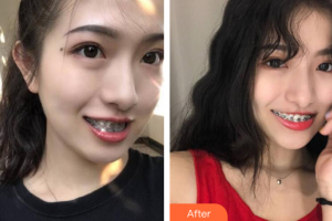 佛山市禪城區(qū)人民醫(yī)院口腔專(zhuān)科醫(yī)院翟煒東整形價(jià)格表附自鎖矯正案例展示