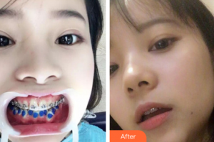 佛山市禪城區(qū)人民醫(yī)院口腔專(zhuān)科醫(yī)院段昌華整形價(jià)格表附金屬矯正案例展示