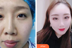 佛山市禪城中心醫(yī)院整形美容科曹碧浪整形價(jià)格表附眼部修復(fù)案例展示