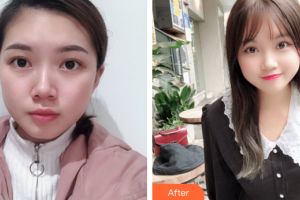 佛山市禪城中心醫(yī)院整形美容科王學(xué)煌整形價(jià)格表附雙眼皮案例展示