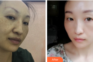 江門(mén)福康醫(yī)學(xué)整形美容醫(yī)院徐靖宏整形價(jià)格表附祛黃褐斑案例展示