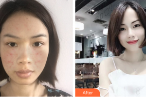 江門(mén)瑪麗整形醫(yī)院李慧瓊整形價(jià)格表附紅藍(lán)光祛痘案例展示