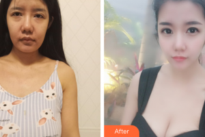 江門(mén)福康醫(yī)學(xué)整形美容醫(yī)院張志軍整形價(jià)格表附自體脂肪隆胸案例展示