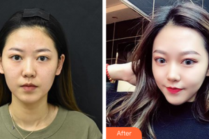 江門(mén)西區(qū)醫(yī)院中醫(yī)美容中心楊英整形價(jià)格表附光子嫩膚案例展示