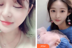 江門(mén)西區(qū)醫(yī)院中醫(yī)美容中心張平整形價(jià)格表附激光美膚激光案例展示