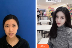 江門(mén)西區(qū)醫(yī)院中醫(yī)美容中心巫云整形價(jià)格表附熱瑪吉抗衰案例展示