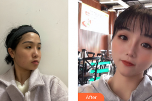 江門(mén)市五邑中醫(yī)院整形科李宇明整形價(jià)格表附埋線提升提升案例展示