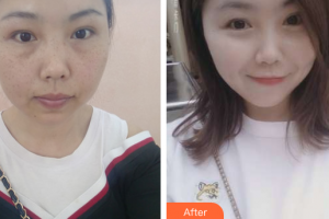 江門(mén)福康醫(yī)學(xué)整形美容醫(yī)院李嘉欣整形價(jià)格表附祛雀斑案例展示