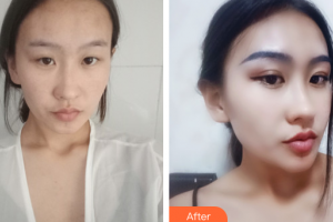 江門(mén)?？滇t(yī)學(xué)整形美容醫(yī)院付洪波整形價(jià)格表附眼部手術(shù)案例展示