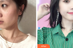 江門(mén)?？滇t(yī)學(xué)整形美容醫(yī)院蔡劍芳整形價(jià)格表附激光美膚激光祛斑案例展示