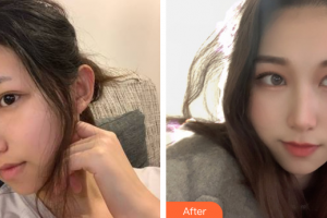 江門(mén)僑都華美美容醫(yī)院歐國(guó)升整形價(jià)格表附面部填充案例展示