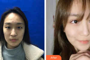 江門僑都華美美容醫(yī)院林社彬院長整形價格表附美眼案例展示