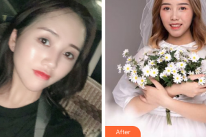 江門(mén)僑都華美美容醫(yī)院常海整形價(jià)格表附眼部整形案例展示