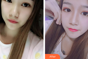 江門僑都華美美容醫(yī)院毛孝中整形價格表附耳軟骨復(fù)合隆鼻案例展示