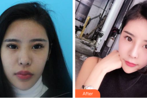 湛江名媛醫(yī)學(xué)美容門診部陳小利整形價格表附鼻整形案例展示