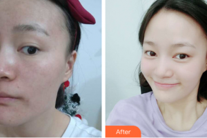 湛江東盟整形美容醫(yī)院沈剛整形價格表附微針案例展示