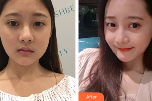 湛江華美整形美容醫(yī)院王軍整形價格表附熱瑪吉案例展示