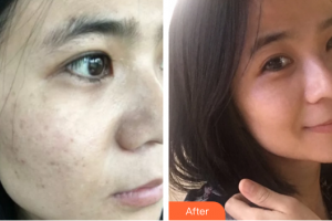 湛江華美整形美容醫(yī)院何慧霞整形價格表附激光祛斑案例展示